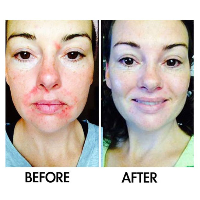 Derm #1 Two-Step Regimen plus FREE Blemish Corrector