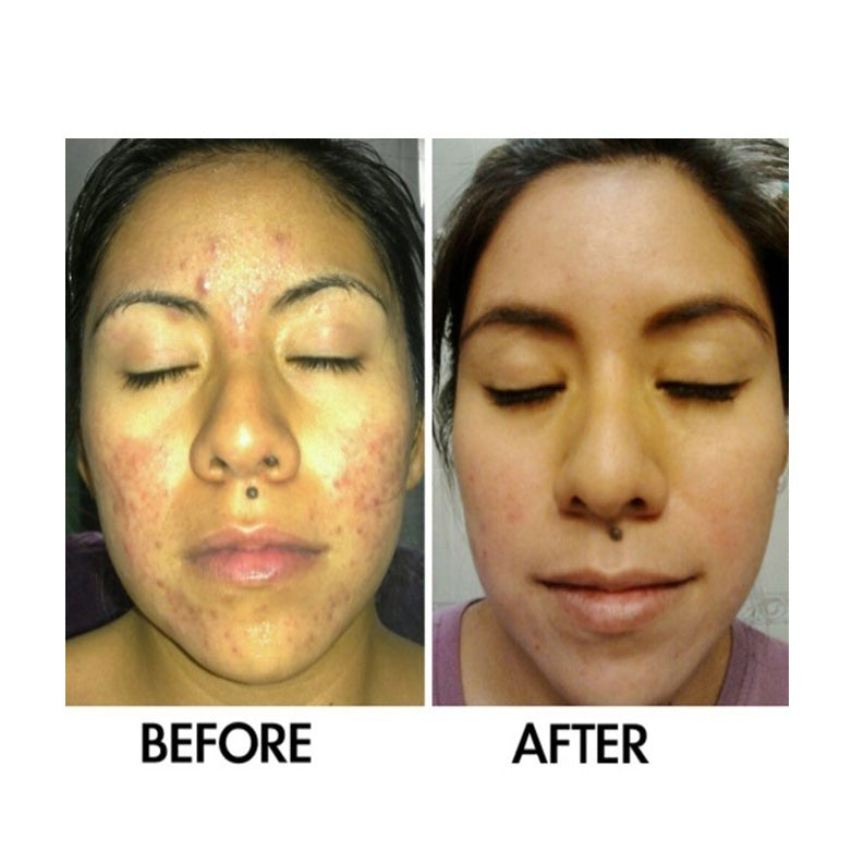 Derm #1 Two-Step Regimen plus FREE Blemish Corrector
