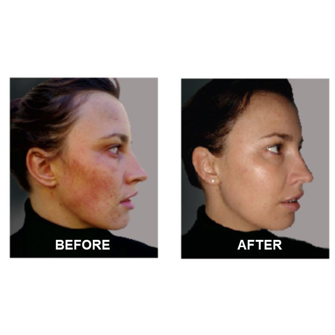 Derm #1 Two-Step Regimen plus FREE Blemish Corrector