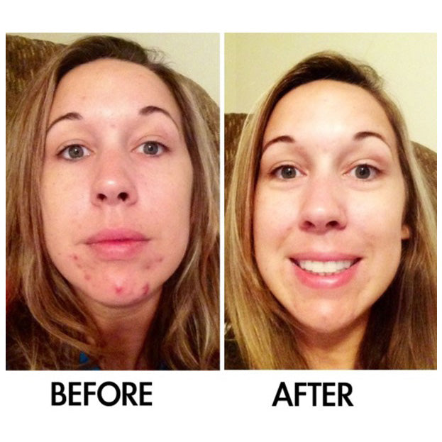 Derm #1 Two-Step Regimen plus FREE Blemish Corrector
